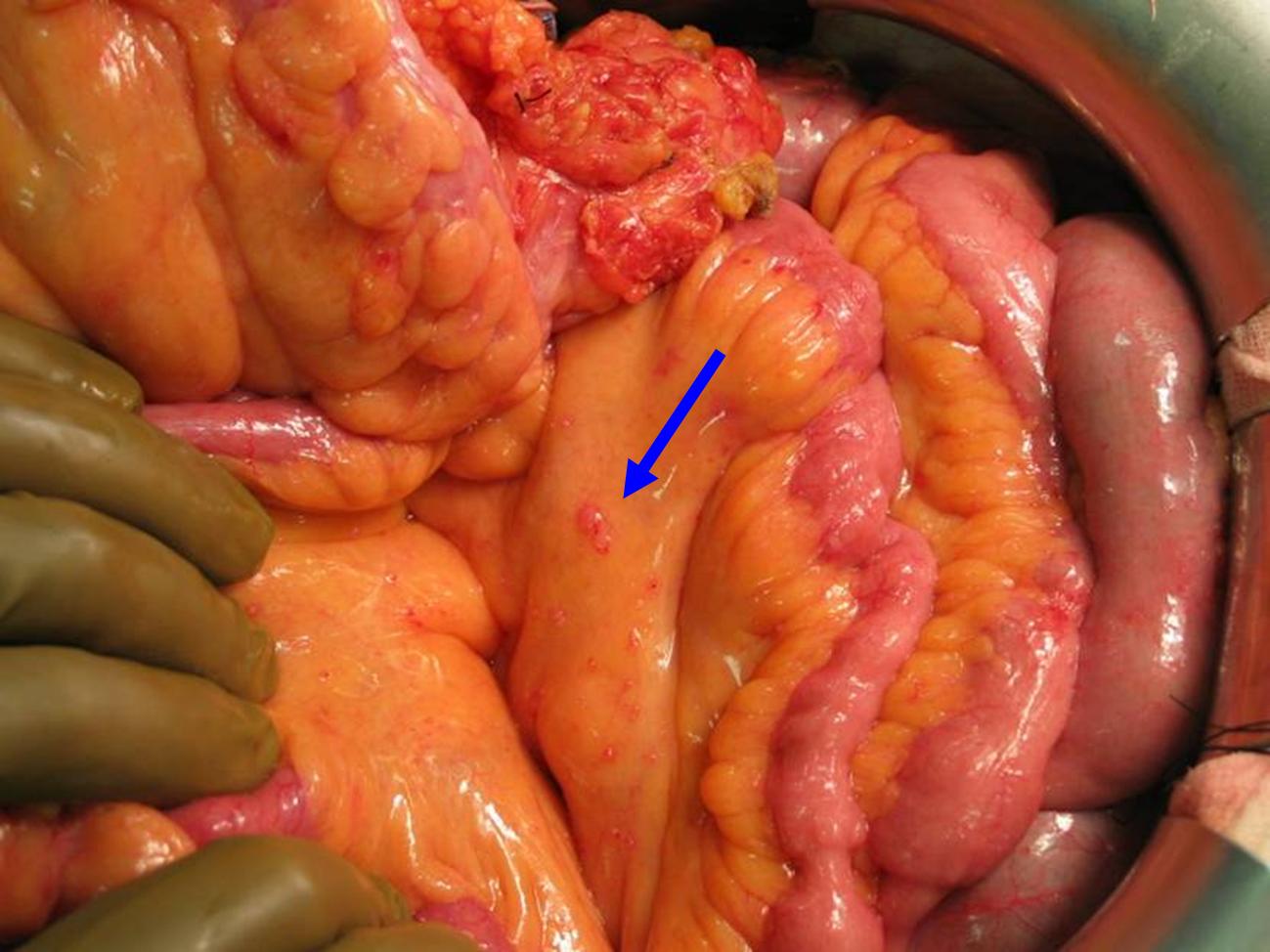 Peritoneal cancer from colon, Šaltinių per metus