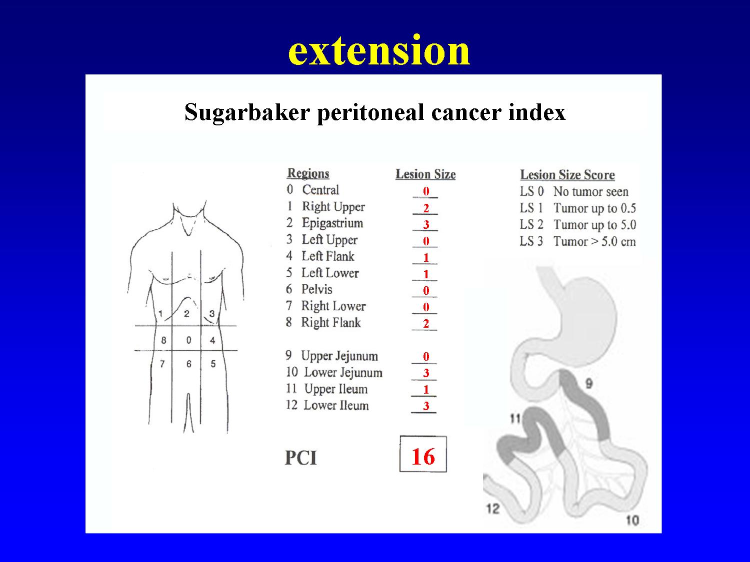 Peritoneal cancer index score, 2Indexul Peritoneal Al Cancerului Peritoneal cancer index