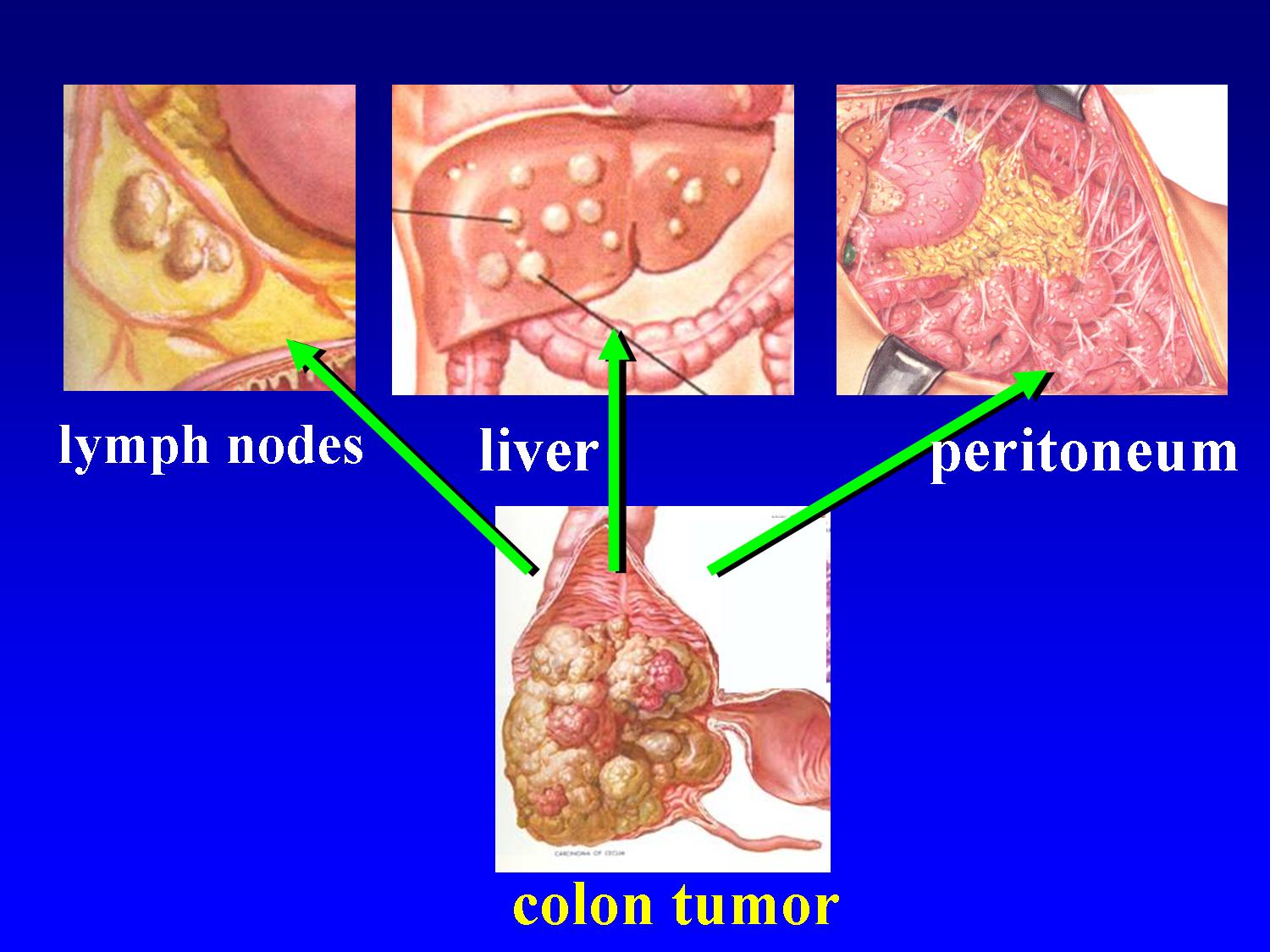 peritoneal cancer end of life