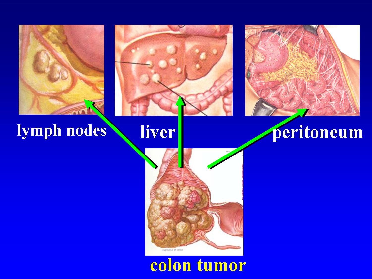 peritoneal cancer treatment uk