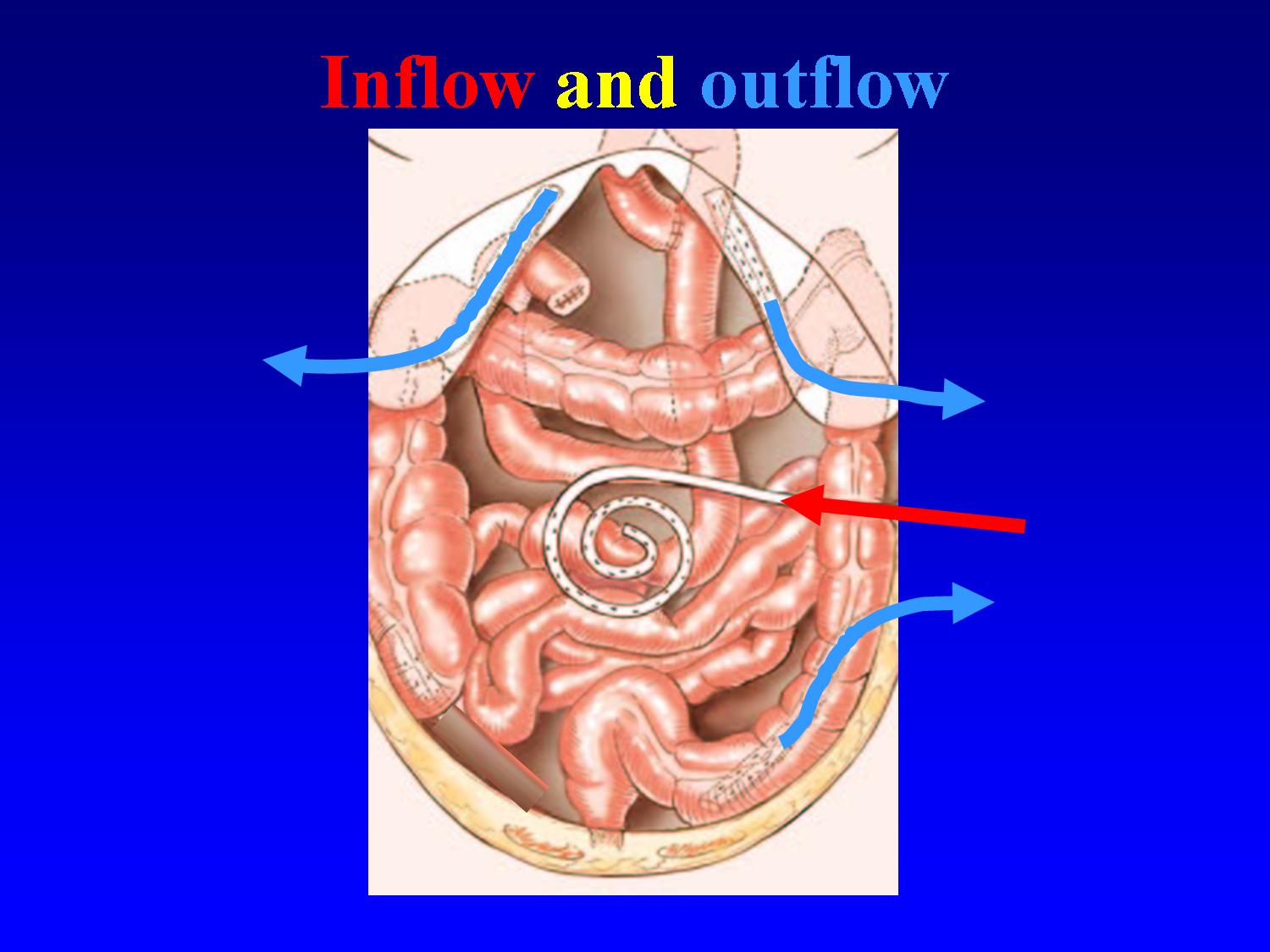 peritoneal cancer blockage)