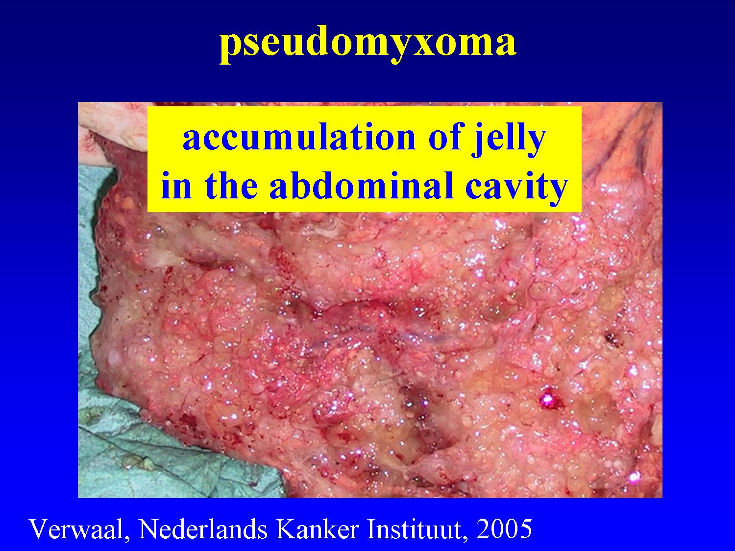 Cancer in abdominal area