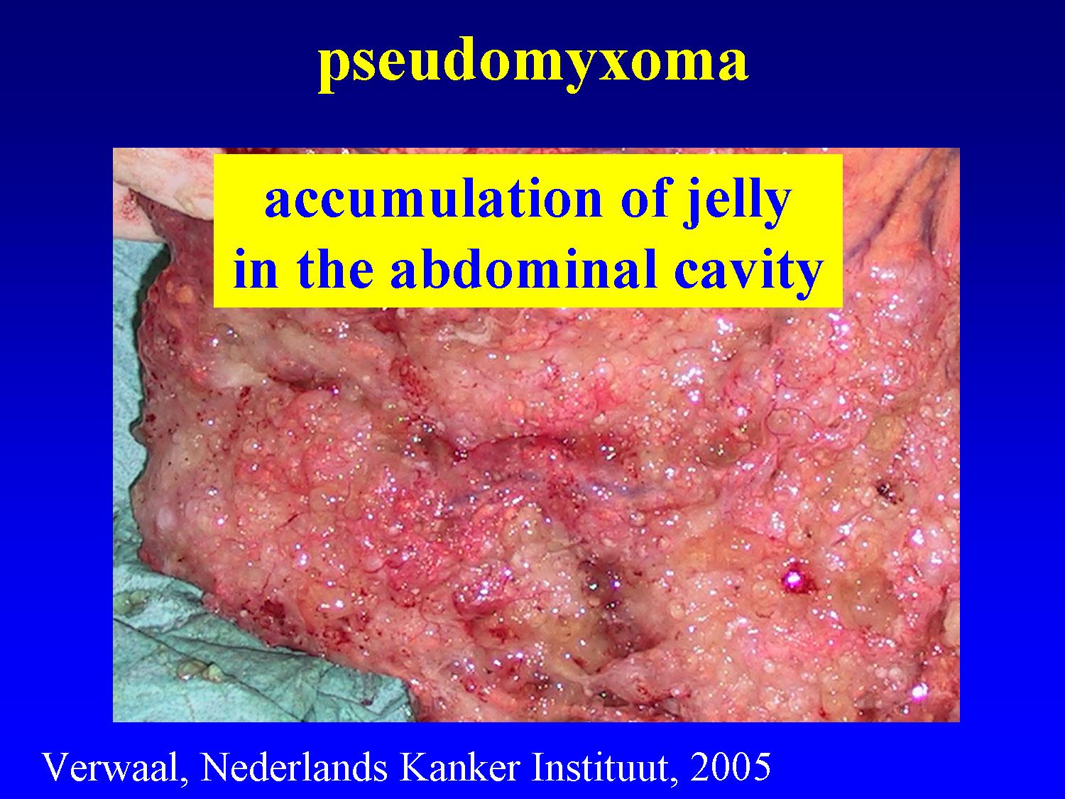 cancer peritoneal secondary que es cancer gastrico avanzado