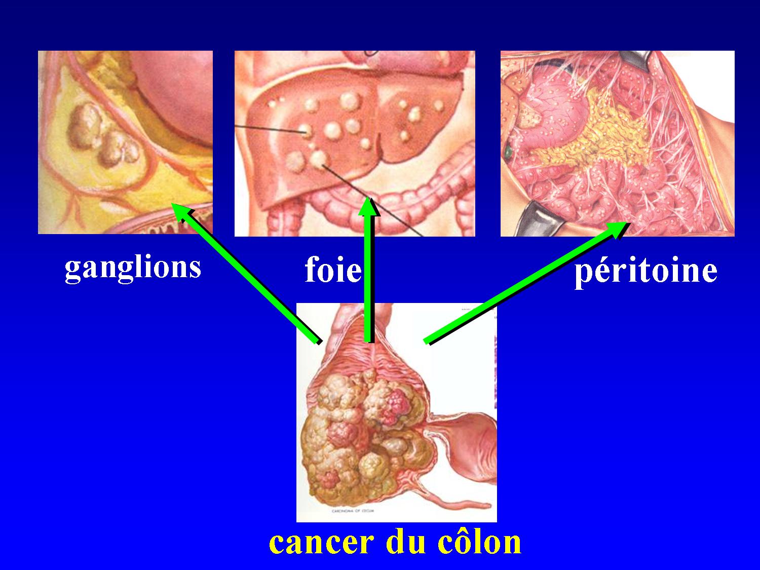 sarcome cancer generalise metastatic cancer natural remedy