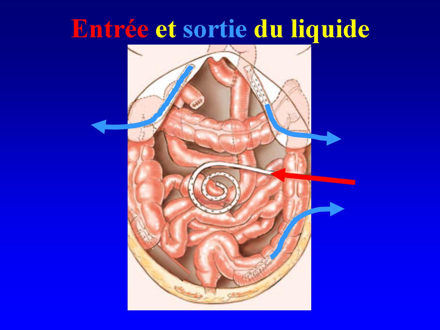 cancer de l'ovaire HIPEC OVHIPEC CHIP chimiothérapie debulking ...