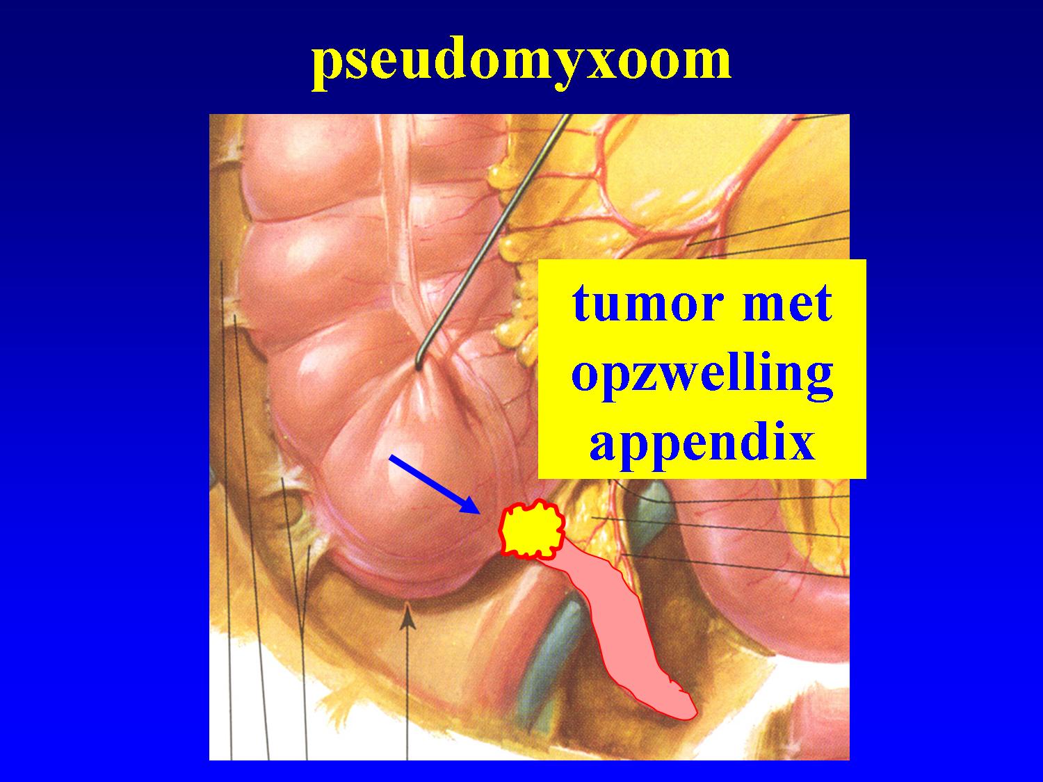 mesothelioma its all we do