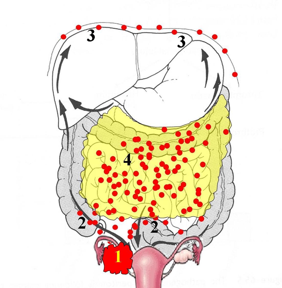 ovarian cancer hipec cancerul gatului